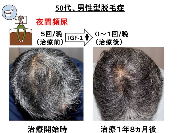 円形脱毛症　病院